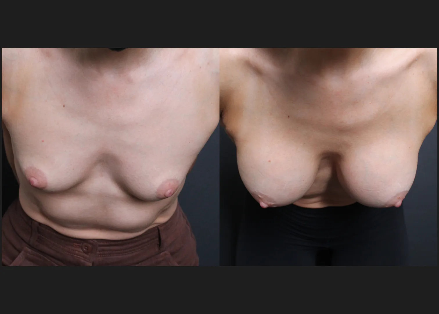 Breast Augmentation Silicone Cohesive Gel Implants Natrelle Inspira Full Profile Smooth Round SSF 295 cc Subpectoral Dual Plane Athletic Female Before After- Cleavage