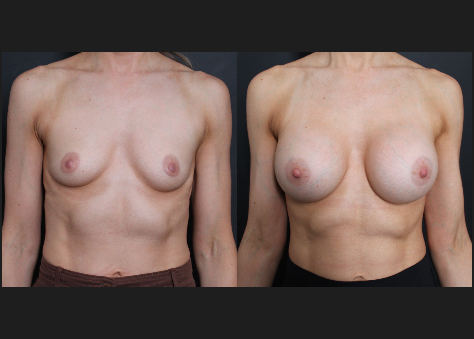 Breast Augmentation Silicone Cohesive Gel Implants Natrelle Inspira Full Profile Smooth Round SSF 295 cc Subpectoral Dual Plane Athletic Female Before After- FRONT