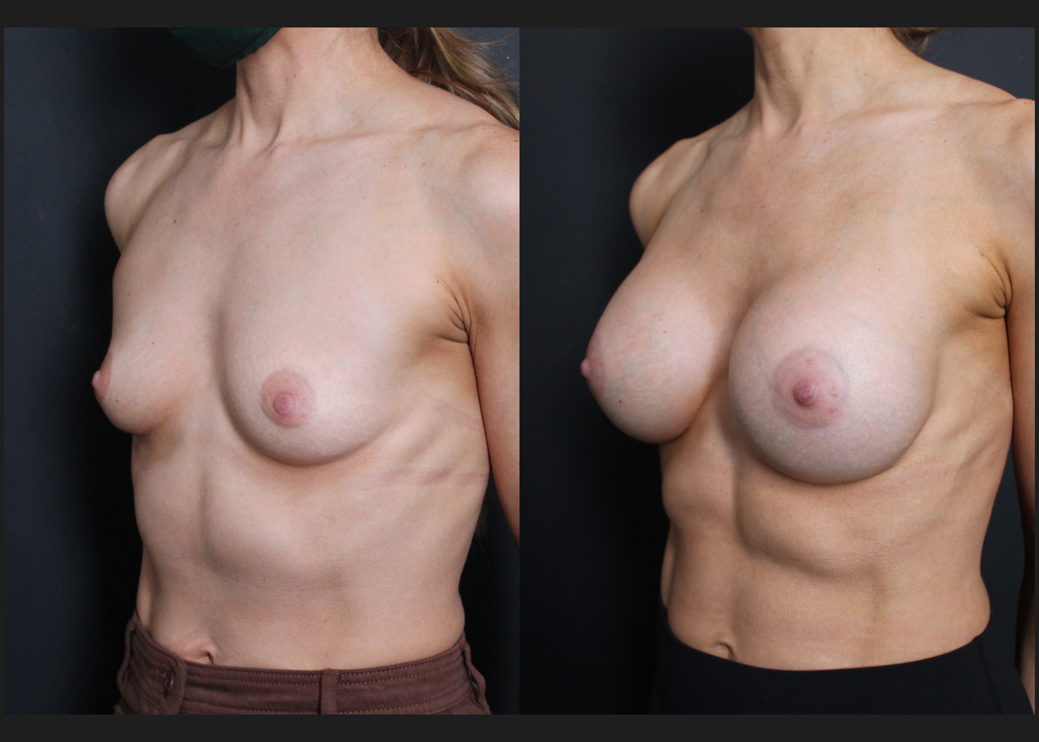 Breast Augmentation Silicone Cohesive Gel Implants Natrelle Inspira Full Profile Smooth Round SSF 295 cc Subpectoral Dual Plane Athletic Female Before After- Left Oblique