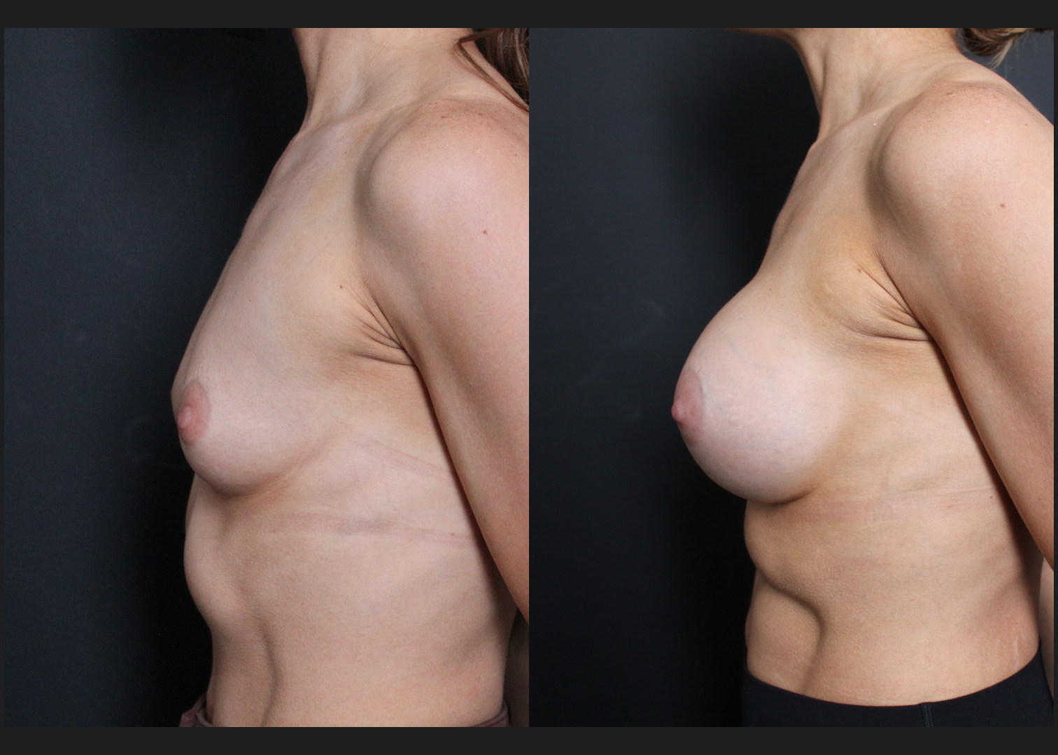 Breast Augmentation Silicone Cohesive Gel Implants Natrelle Inspira Full Profile Smooth Round SSF 295 cc Subpectoral Dual Plane Athletic Female Before After- Left_