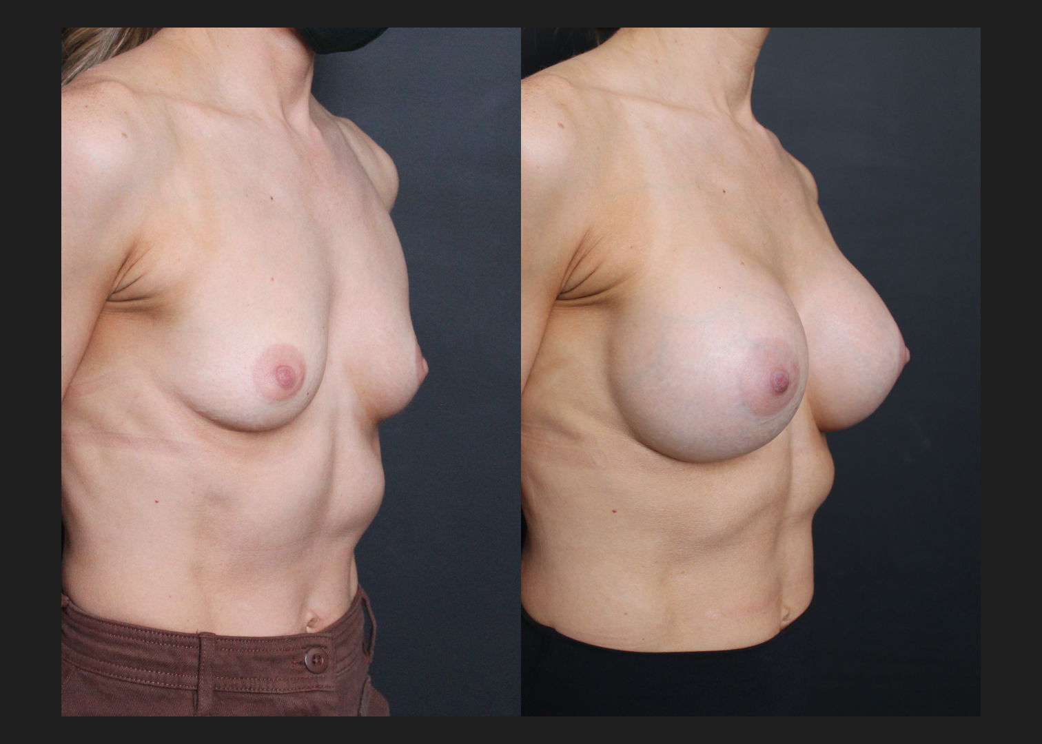 Breast Augmentation Silicone Cohesive Gel Implants Natrelle Inspira Full Profile Smooth Round SSF 295 cc Subpectoral Dual Plane Athletic Female Before After- Right Oblique