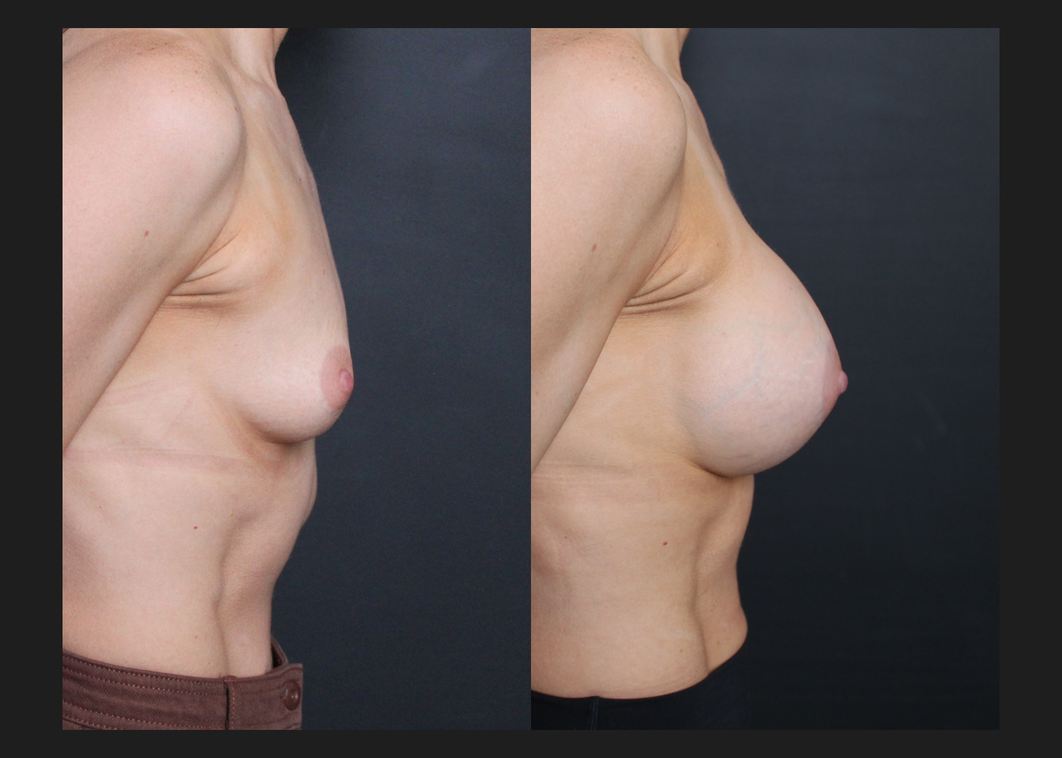 Breast Augmentation Silicone Cohesive Gel Implants Natrelle Inspira Full Profile Smooth Round SSF 295 cc Subpectoral Dual Plane Athletic Female Before After- Right