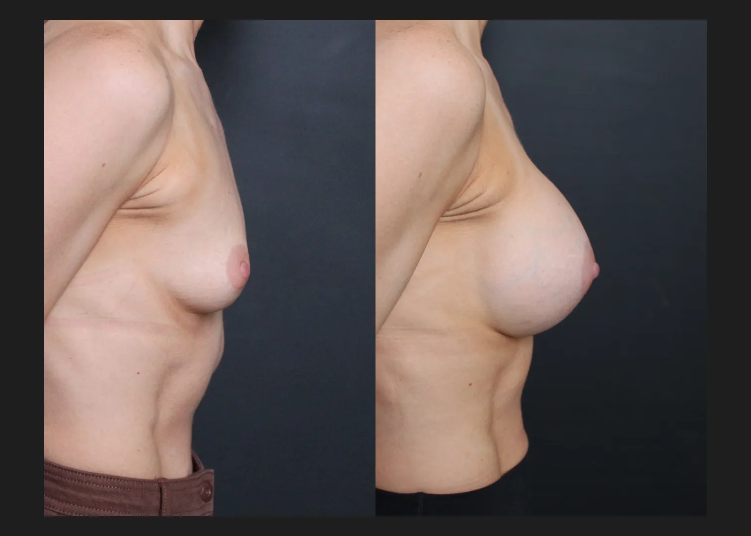 Breast Augmentation Silicone Cohesive Gel Implants Natrelle Inspira Full Profile Smooth Round SSF 295 cc Subpectoral Dual Plane Athletic Female Before After- Right