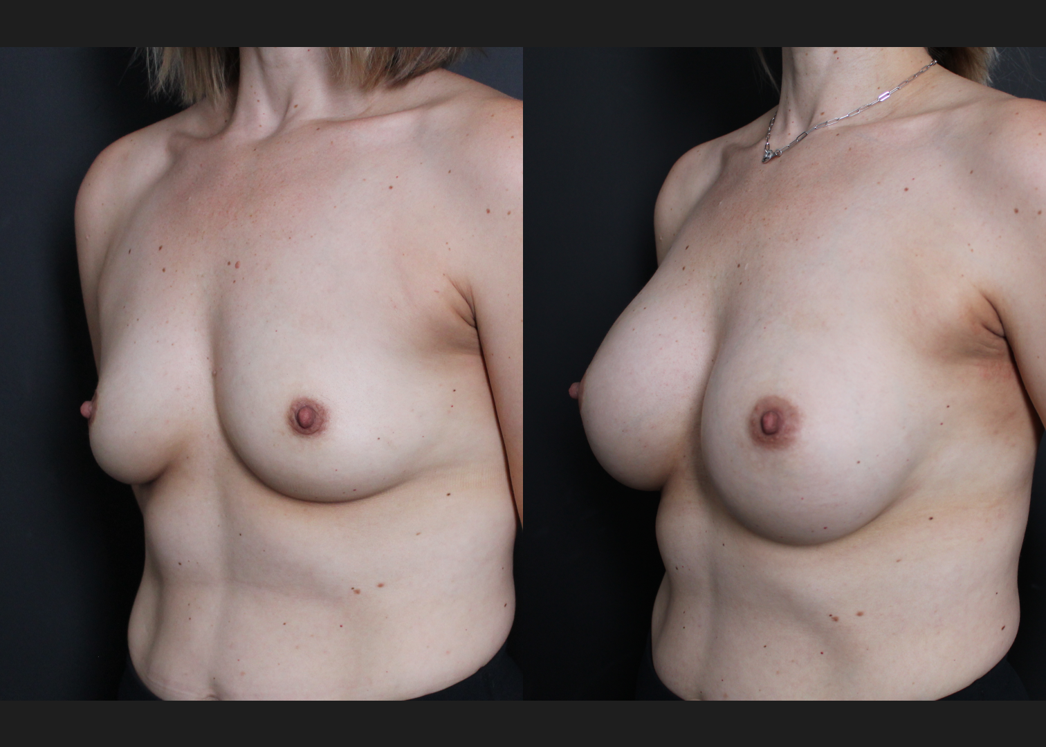 Breast Augmentation natrelle inspira smooth round moderate profile silicone gummy bear implants 345 cc subpectoral dual plane before after- left oblique