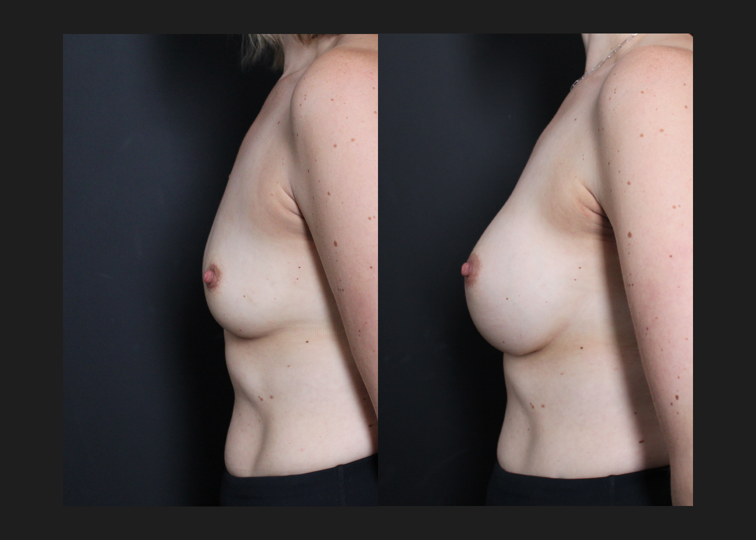 Breast Augmentation natrelle inspira smooth round moderate profile silicone gummy bear implants 345 cc subpectoral dual plane before after- left