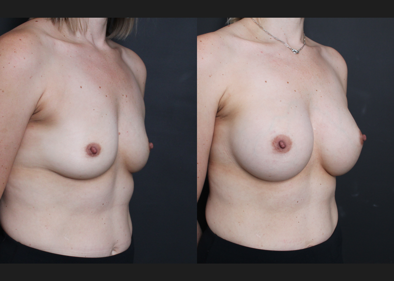 Breast Augmentation natrelle inspira smooth round moderate profile silicone gummy bear implants 345 cc subpectoral dual plane before after- right oblique
