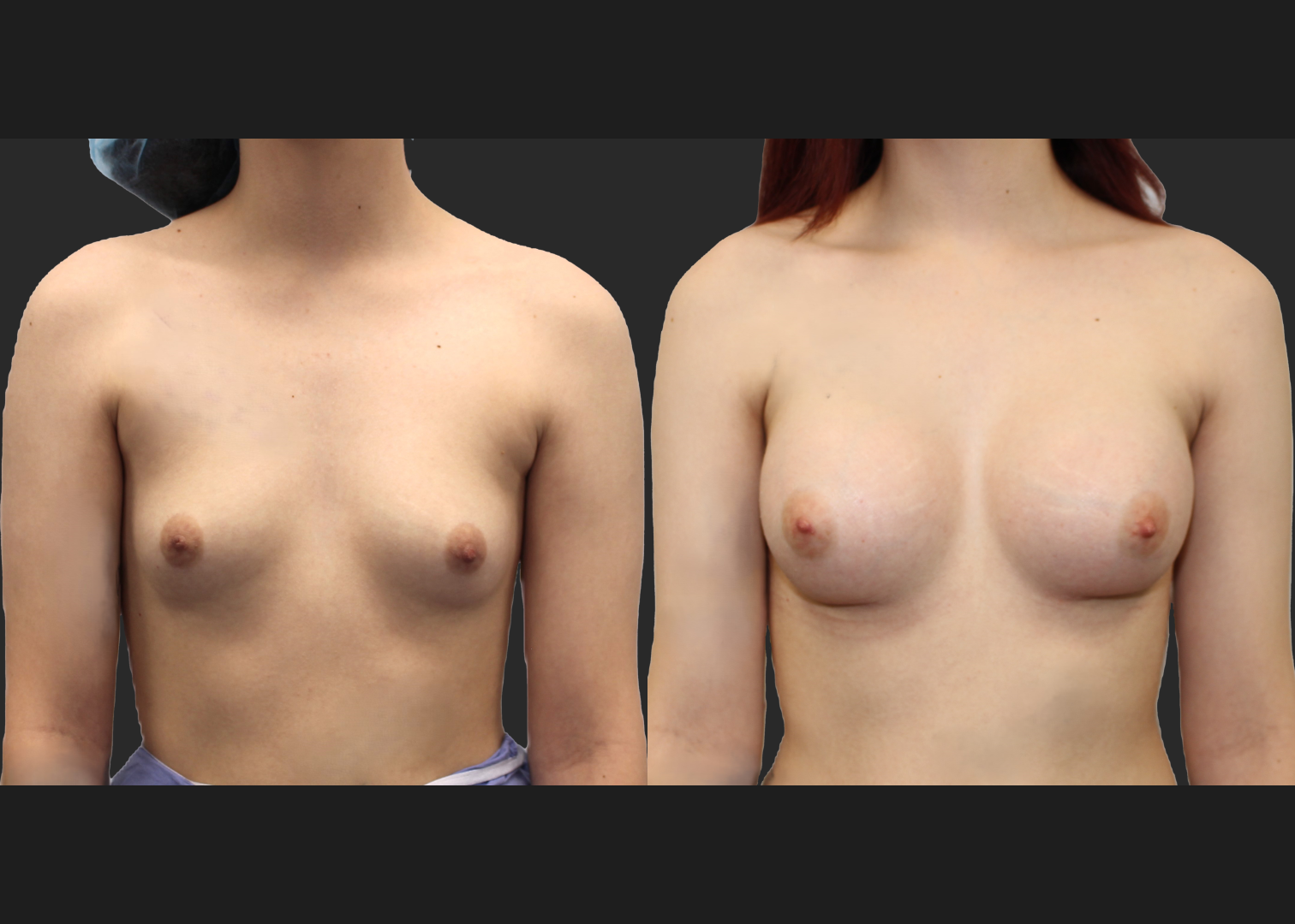Breast Augmentation young female subfascial SSF 325 cc Natrelle inspira full profile gummy bear silicone implants before after- front