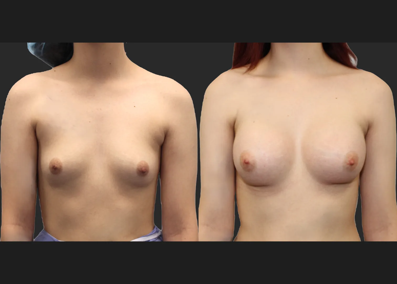 Breast Augmentation young female subfascial SSF 325 cc Natrelle inspira full profile gummy bear silicone implants before after- front