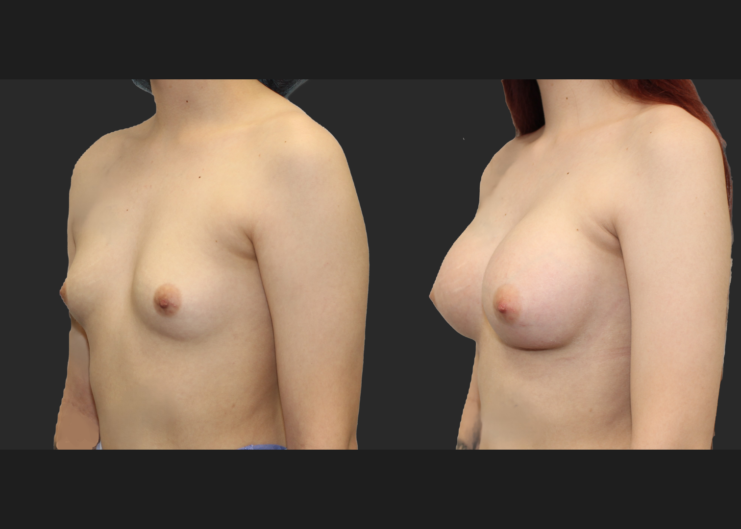 Breast Augmentation young female subfascial SSF 325 cc Natrelle inspira full profile gummy bear silicone implants before after- left oblique