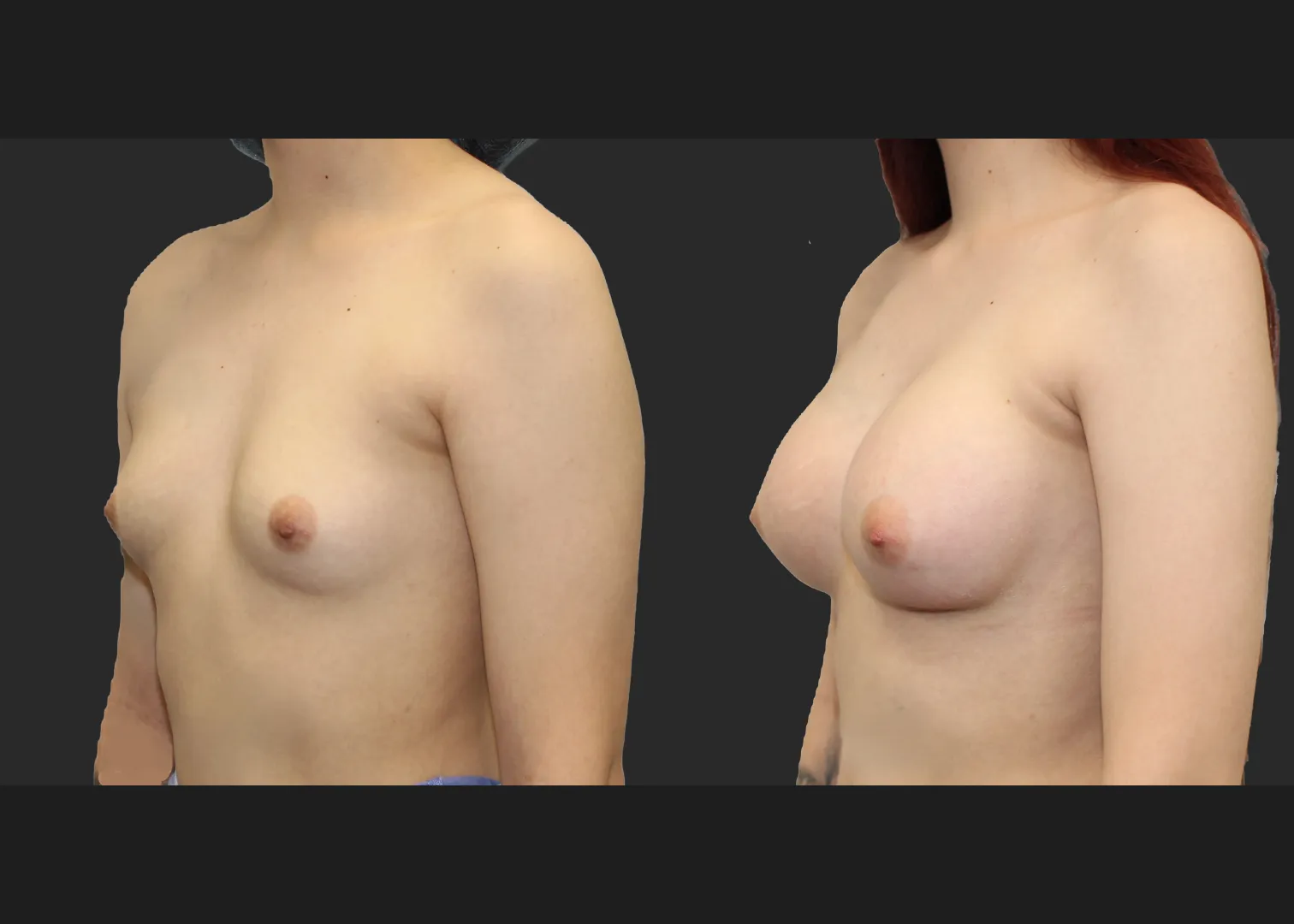 Breast Augmentation young female subfascial SSF 325 cc Natrelle inspira full profile gummy bear silicone implants before after- left oblique