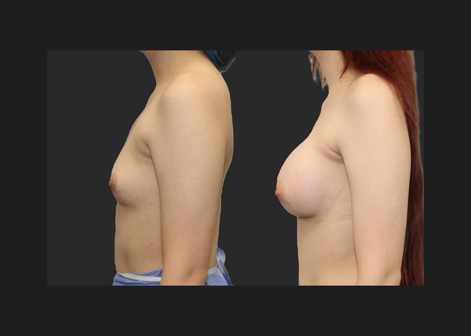 Breast Augmentation young female subfascial SSF 325 cc Natrelle inspira full profile gummy bear silicone implants before after- left