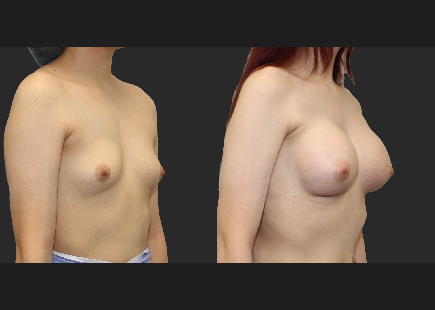 Breast Augmentation young female subfascial SSF 325 cc Natrelle inspira full profile gummy bear silicone implants before after- right oblique