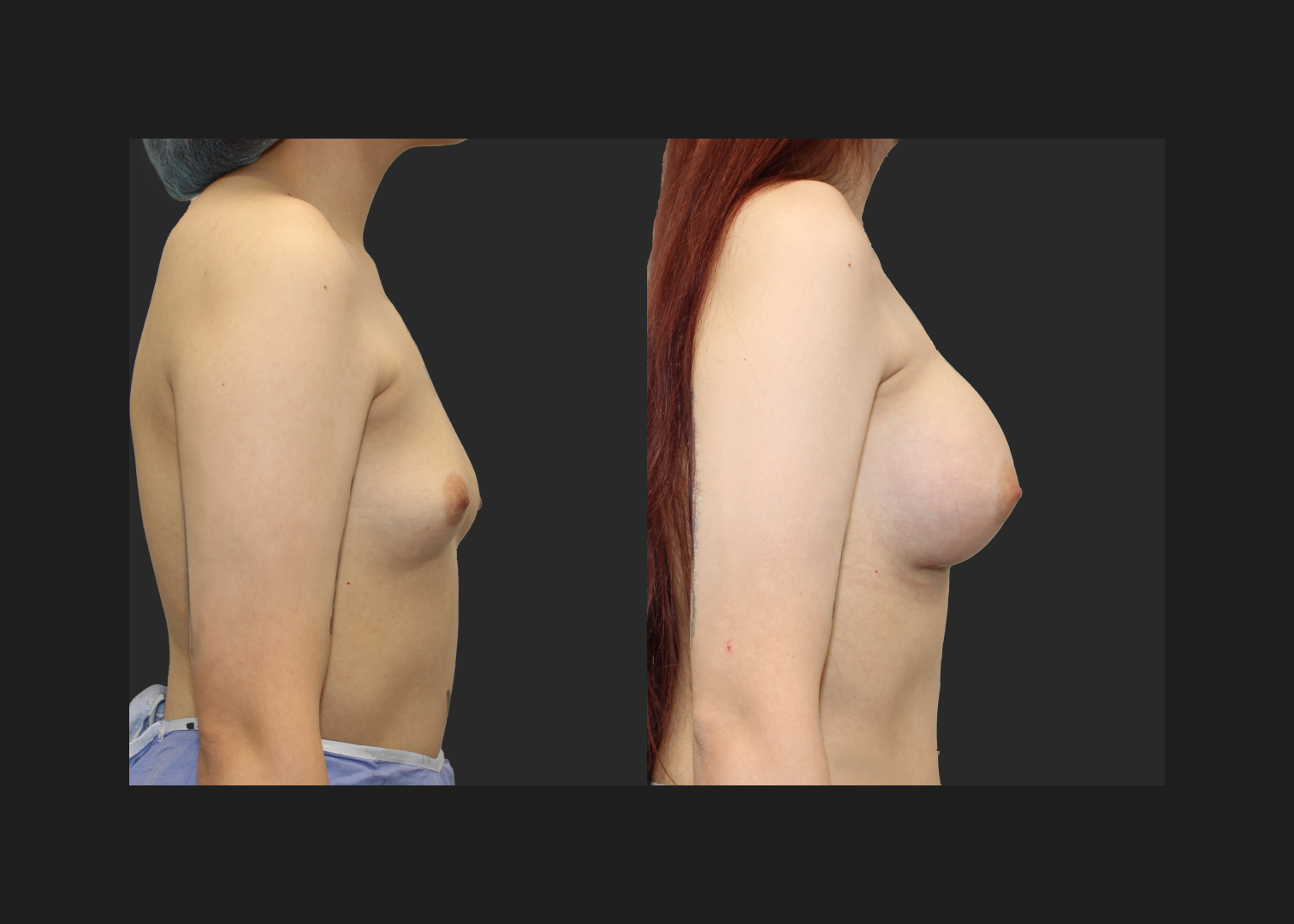 Breast Augmentation young female subfascial SSF 325 cc Natrelle inspira full profile gummy bear silicone implants before after- right