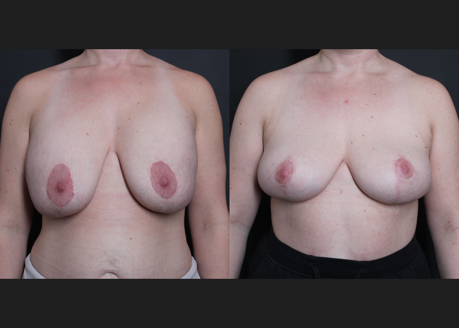 Breast Explant Implant Removal Revision Mastopexy Before After- Front