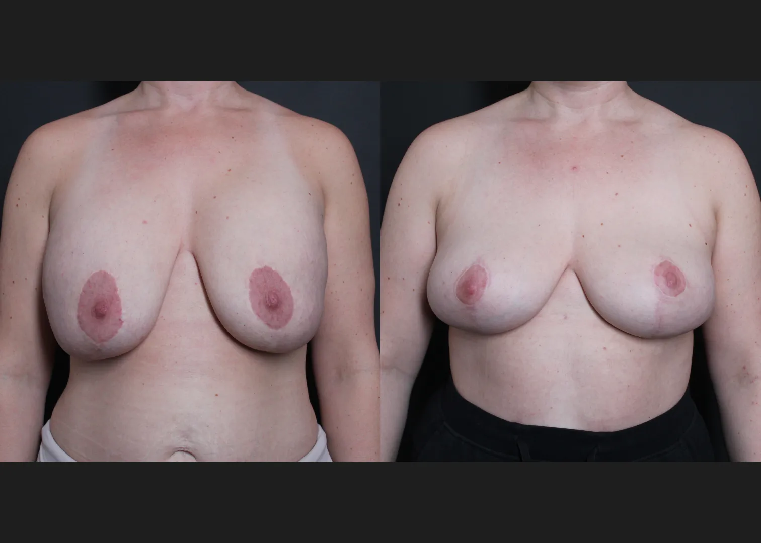 Breast Explant Implant Removal Revision Mastopexy Before After- Front