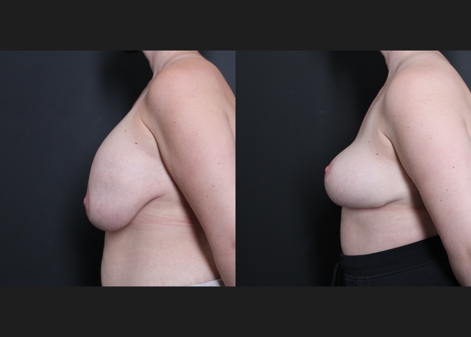 Breast Explant Implant Removal Revision Mastopexy Before After- Left