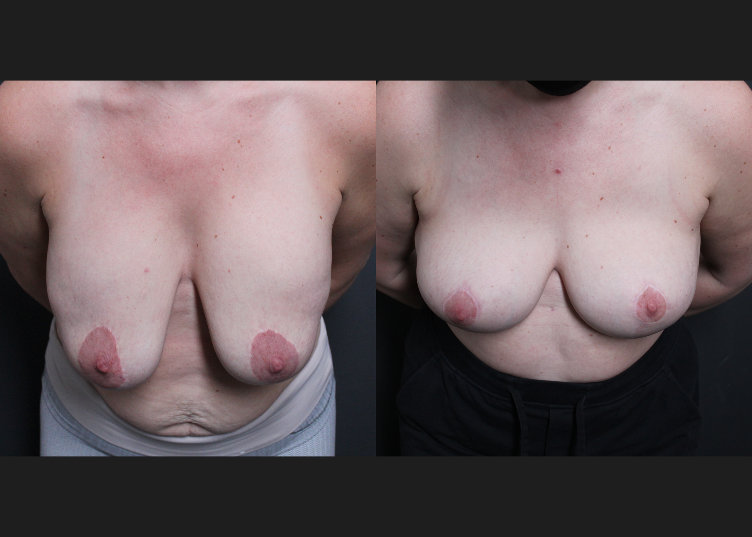 Breast Explant Implant Removal Revision Mastopexy Before After- cleavage