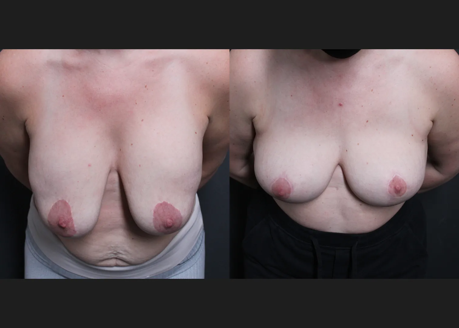 Breast Explant Implant Removal Revision Mastopexy Before After- cleavage