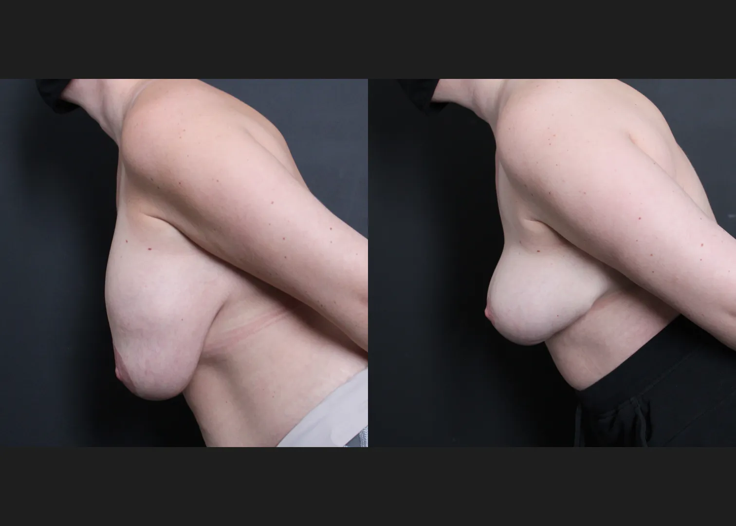Breast Explant Implant Removal Revision Mastopexy Before After- left bent