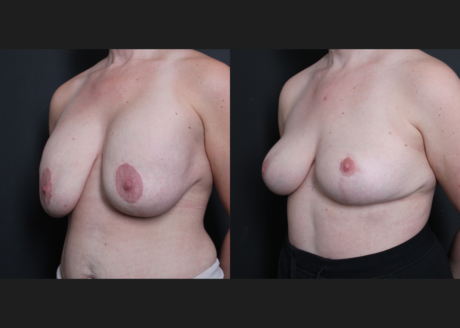 Breast Explant Implant Removal Revision Mastopexy Before After- left oblique