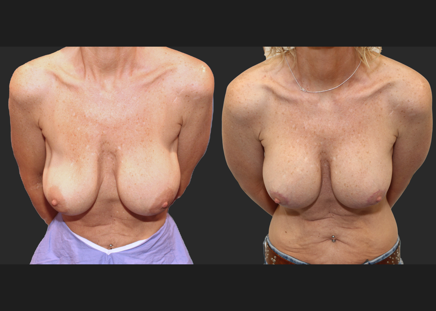 Breast Implant Revision Augmentation Mastopexy Galaflex mesh exchange saline to silicone implants before after- cleavage