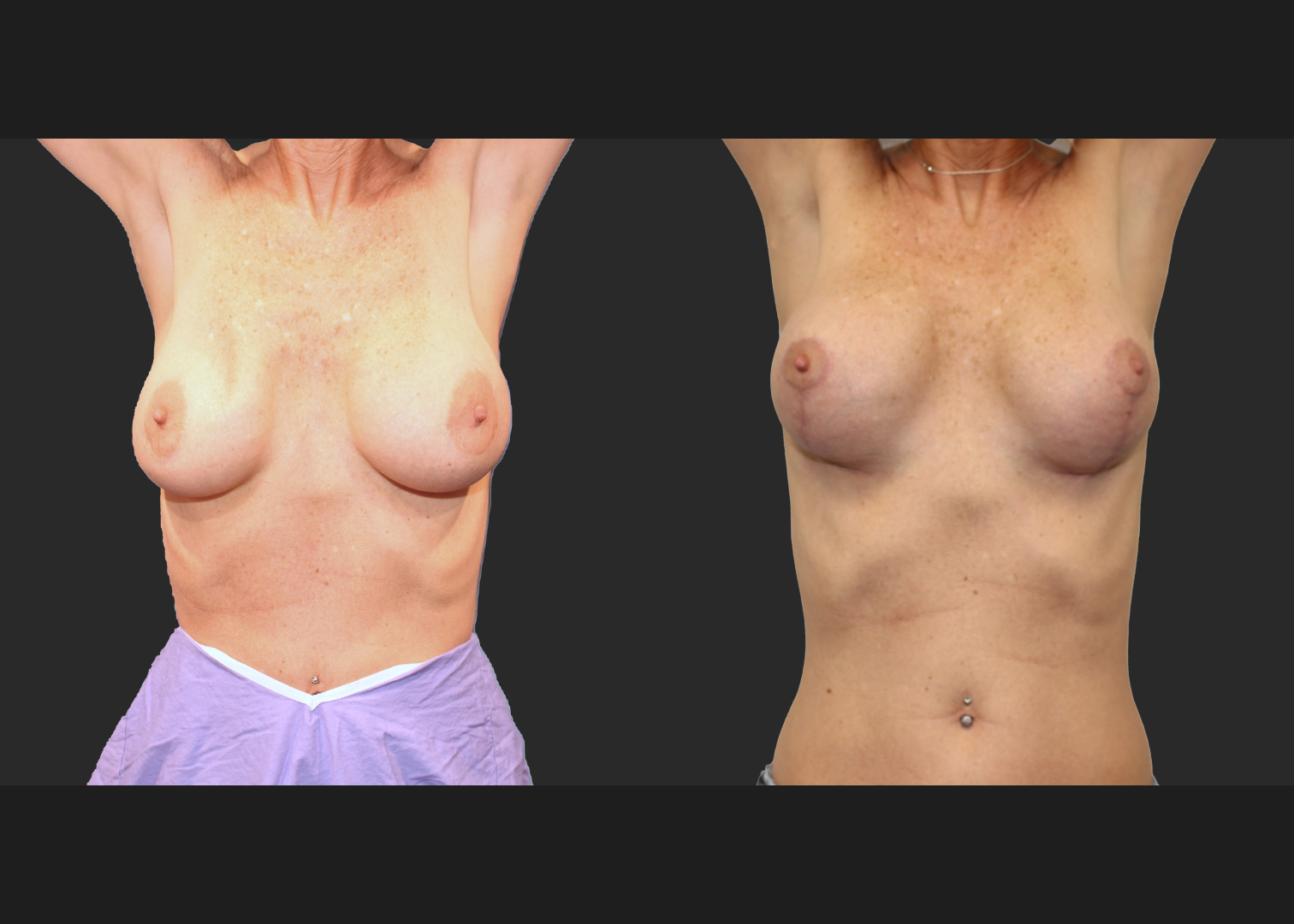 Breast Implant Revision Augmentation Mastopexy Galaflex mesh exchange saline to silicone implants before after- front arms up