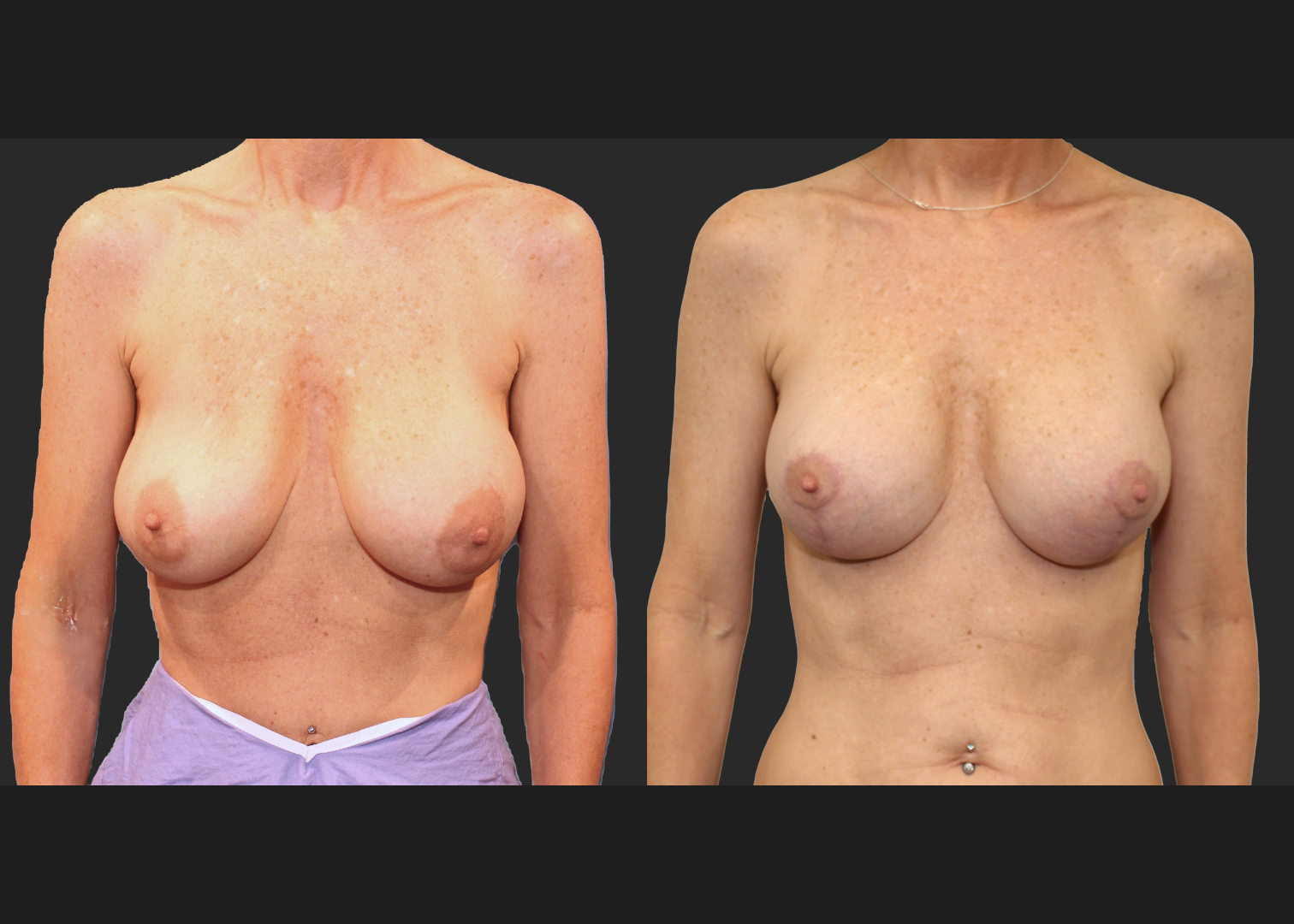 Breast Implant Revision Augmentation Mastopexy Galaflex mesh exchange saline to silicone implants before after- front