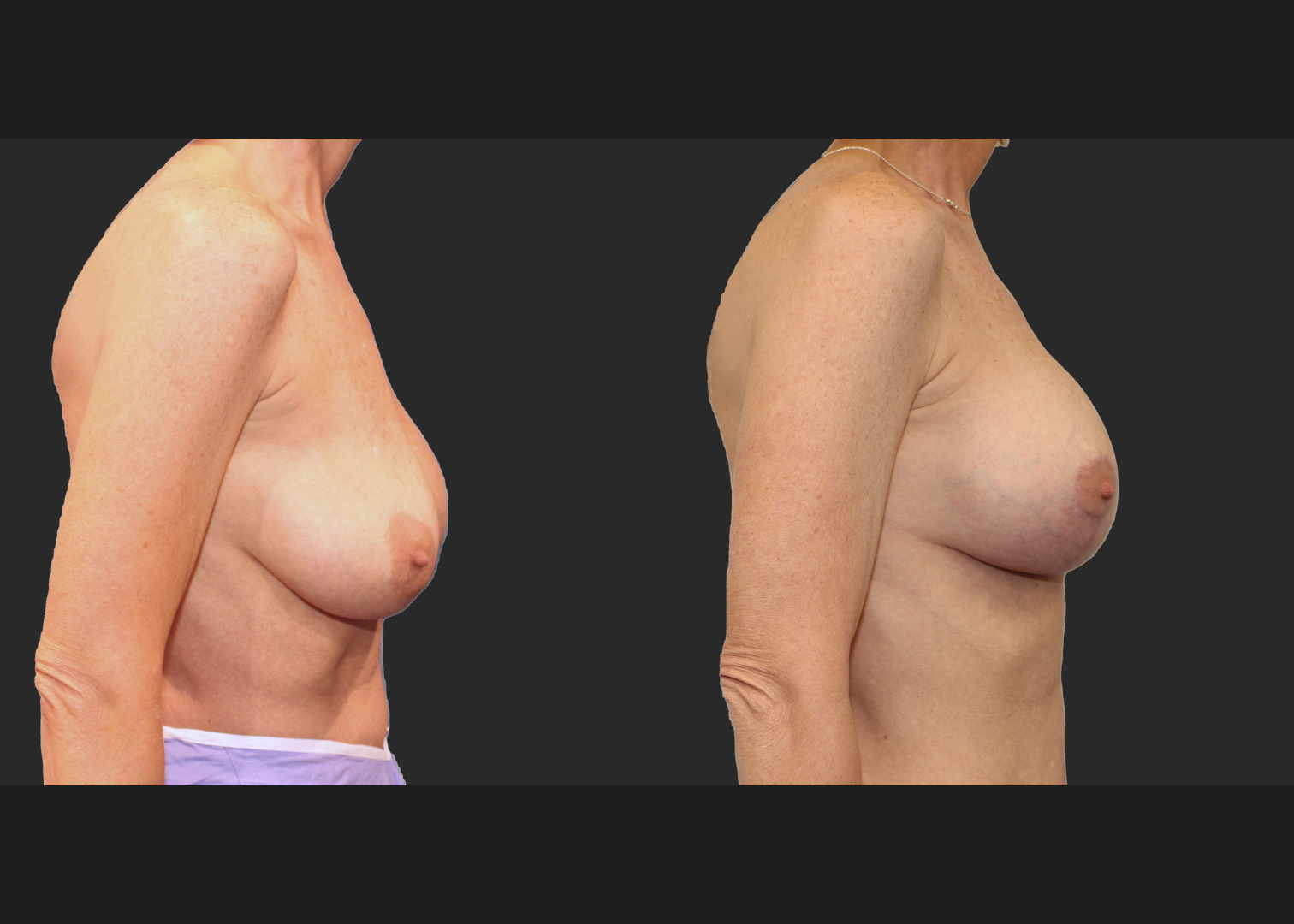 Breast Implant Revision Augmentation Mastopexy Galaflex mesh exchange saline to silicone implants before after- right