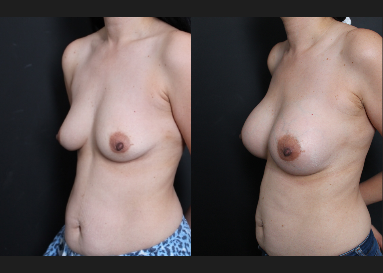Breast augmentation Sientra HSC+ smooth round moderate plus profile silicone gel gummy bear implants 285 cc subfascial before after- left oblique