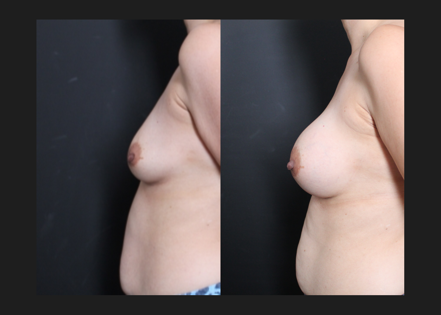 Breast augmentation Sientra HSC+ smooth round moderate plus profile silicone gel gummy bear implants 285 cc subfascial before after- left