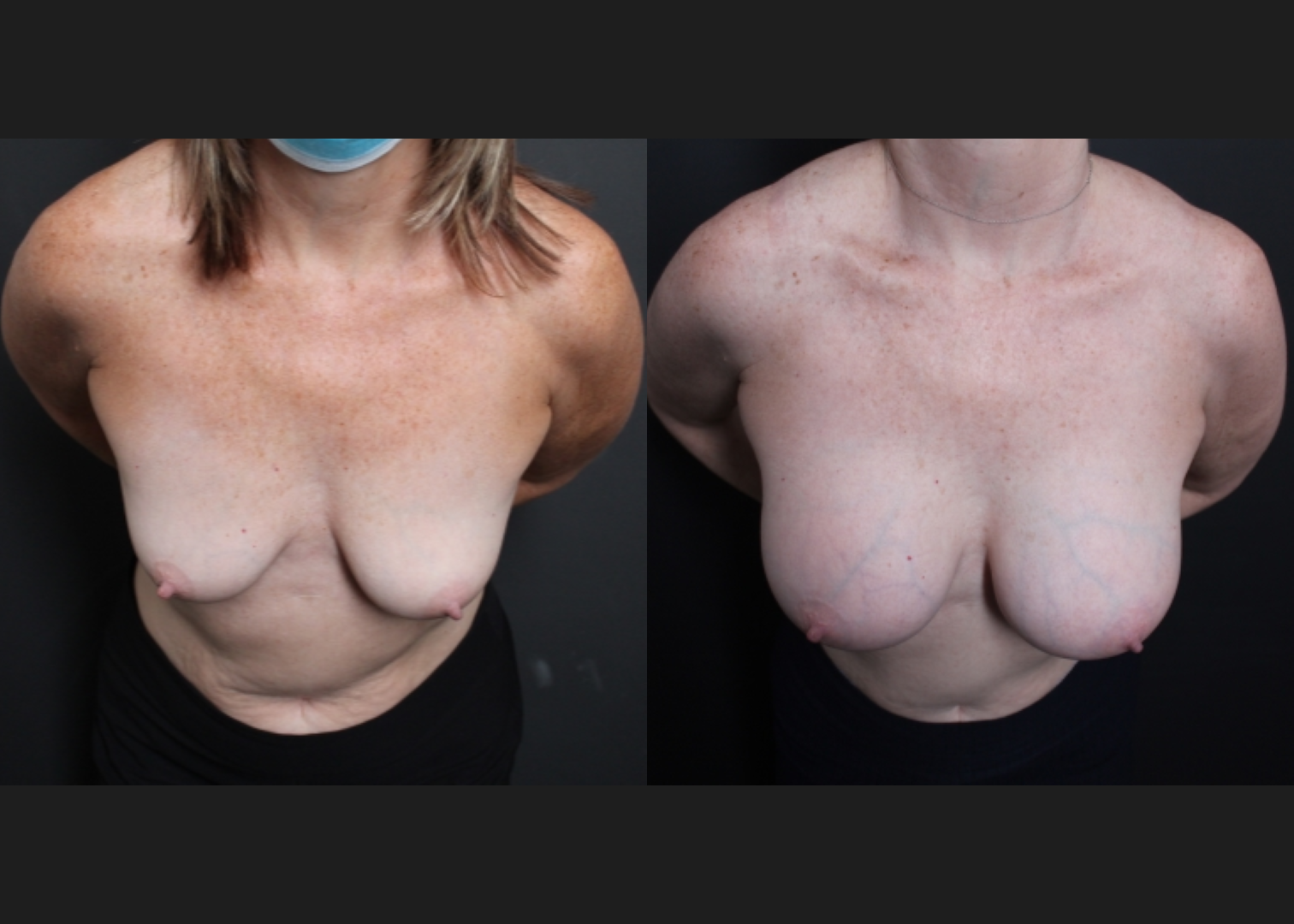 Breast augmentation sientra HSC+ smooth round high profile silicone gel gummy bear implants 415 cc subfascial before after- cleavage