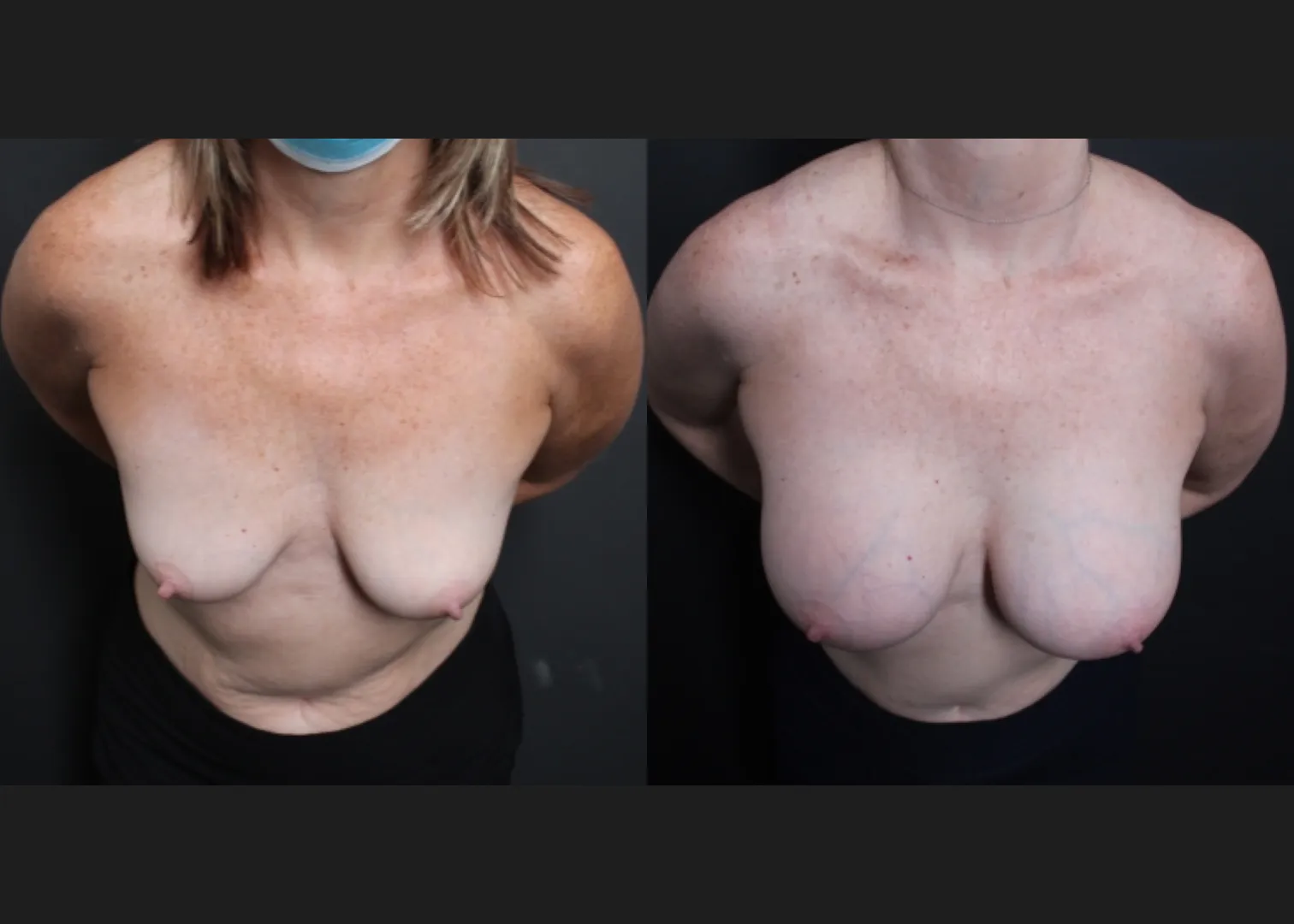 Breast augmentation sientra HSC+ smooth round high profile silicone gel gummy bear implants 415 cc subfascial before after- cleavage
