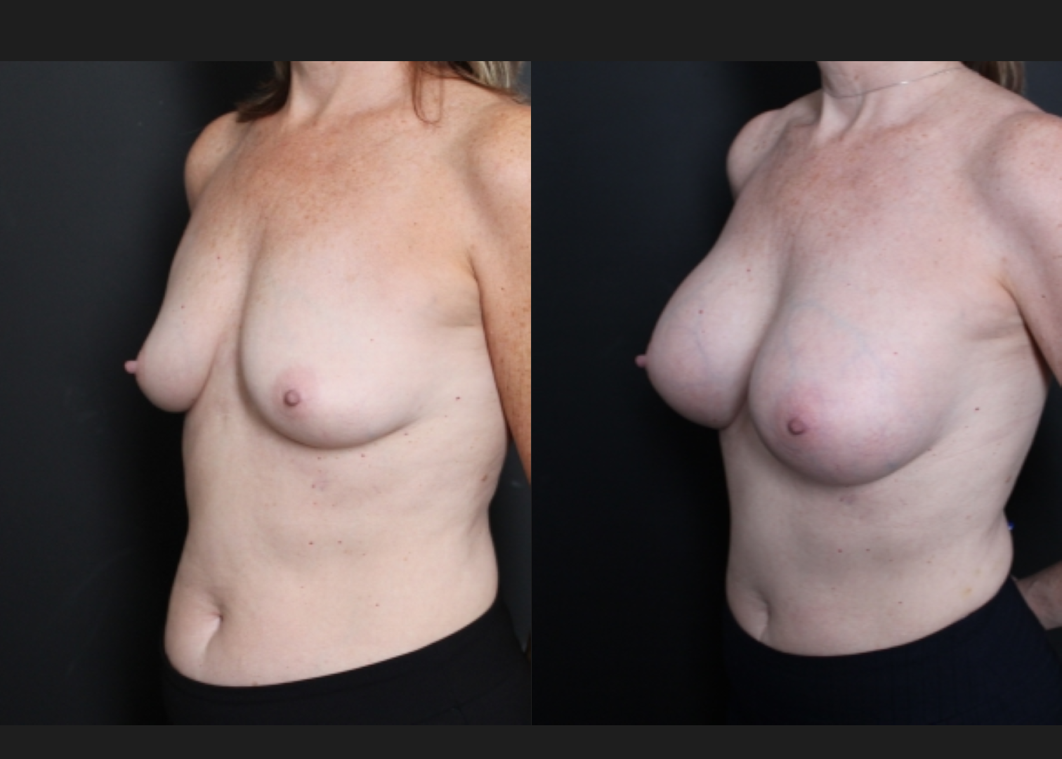 Breast augmentation sientra HSC+ smooth round high profile silicone gel gummy bear implants 415 cc subfascial before after- left oblique