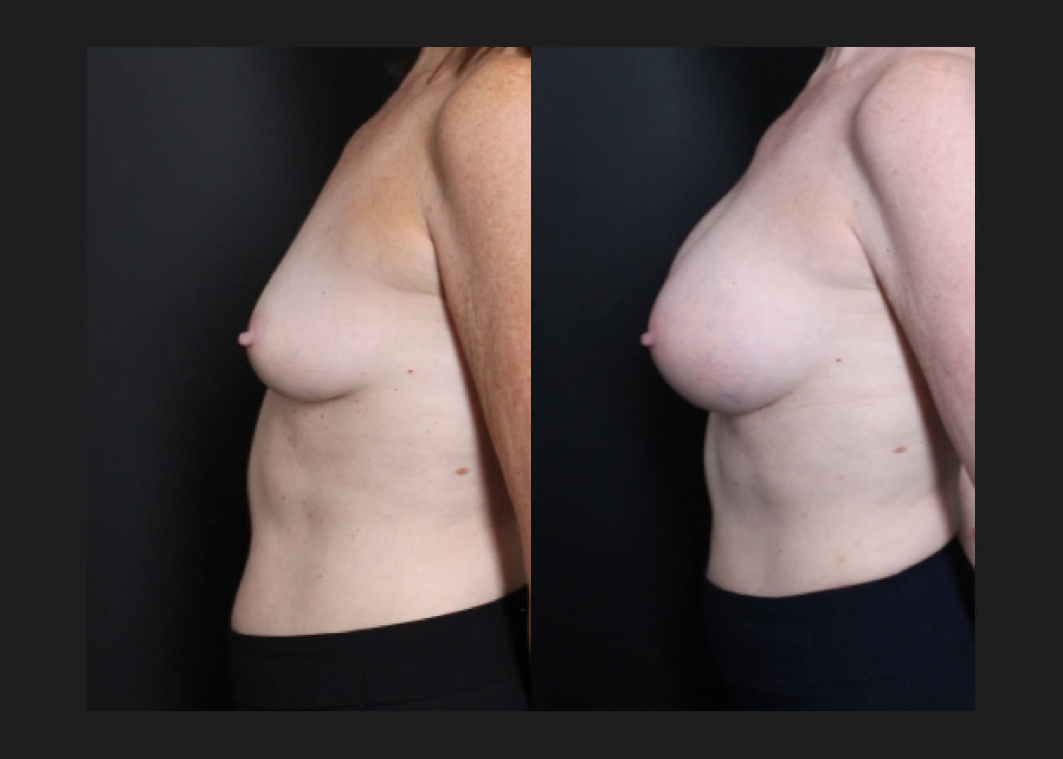 Breast augmentation sientra HSC+ smooth round high profile silicone gel gummy bear implants 415 cc subfascial before after- left