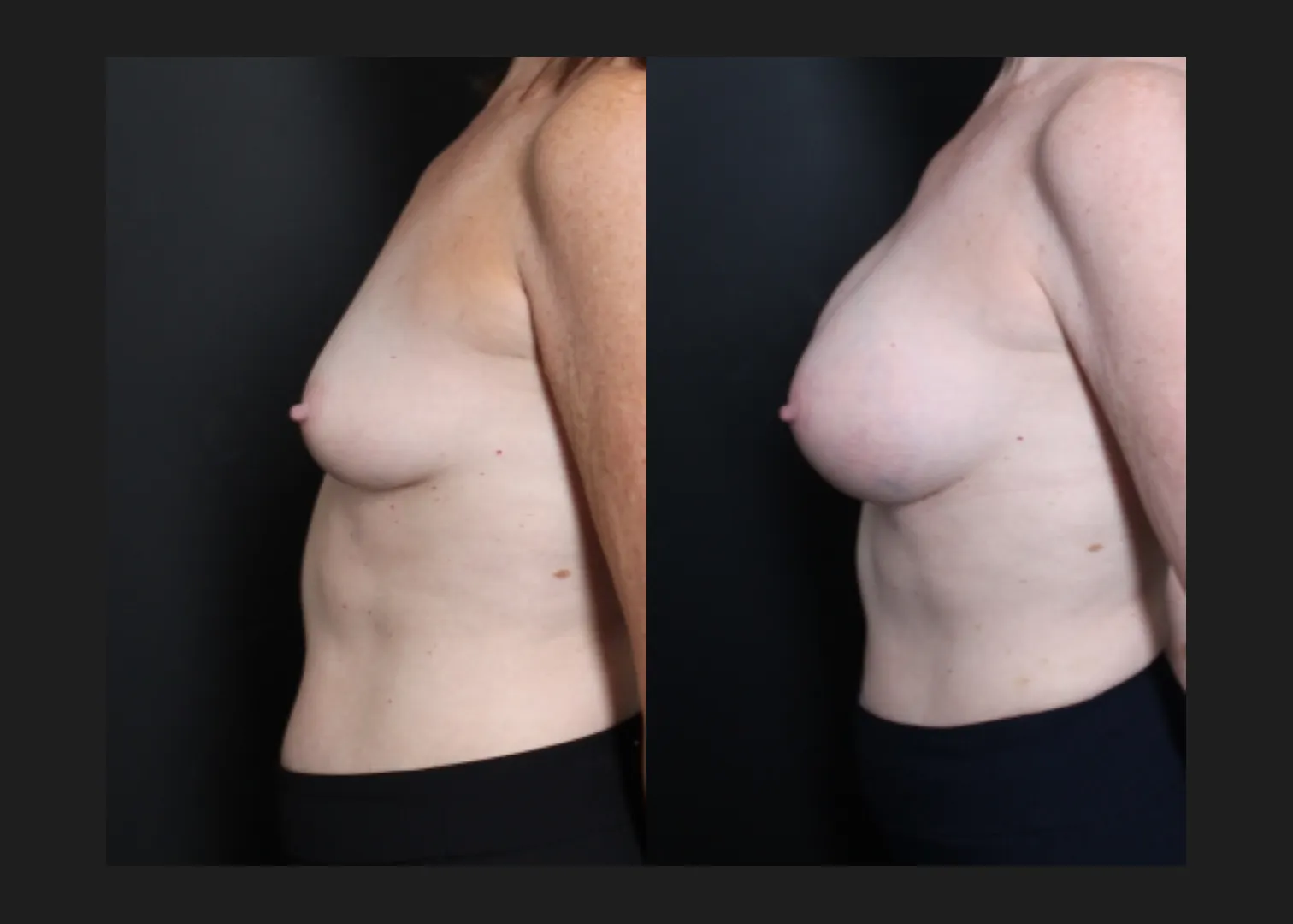 Breast augmentation sientra HSC+ smooth round high profile silicone gel gummy bear implants 415 cc subfascial before after- left