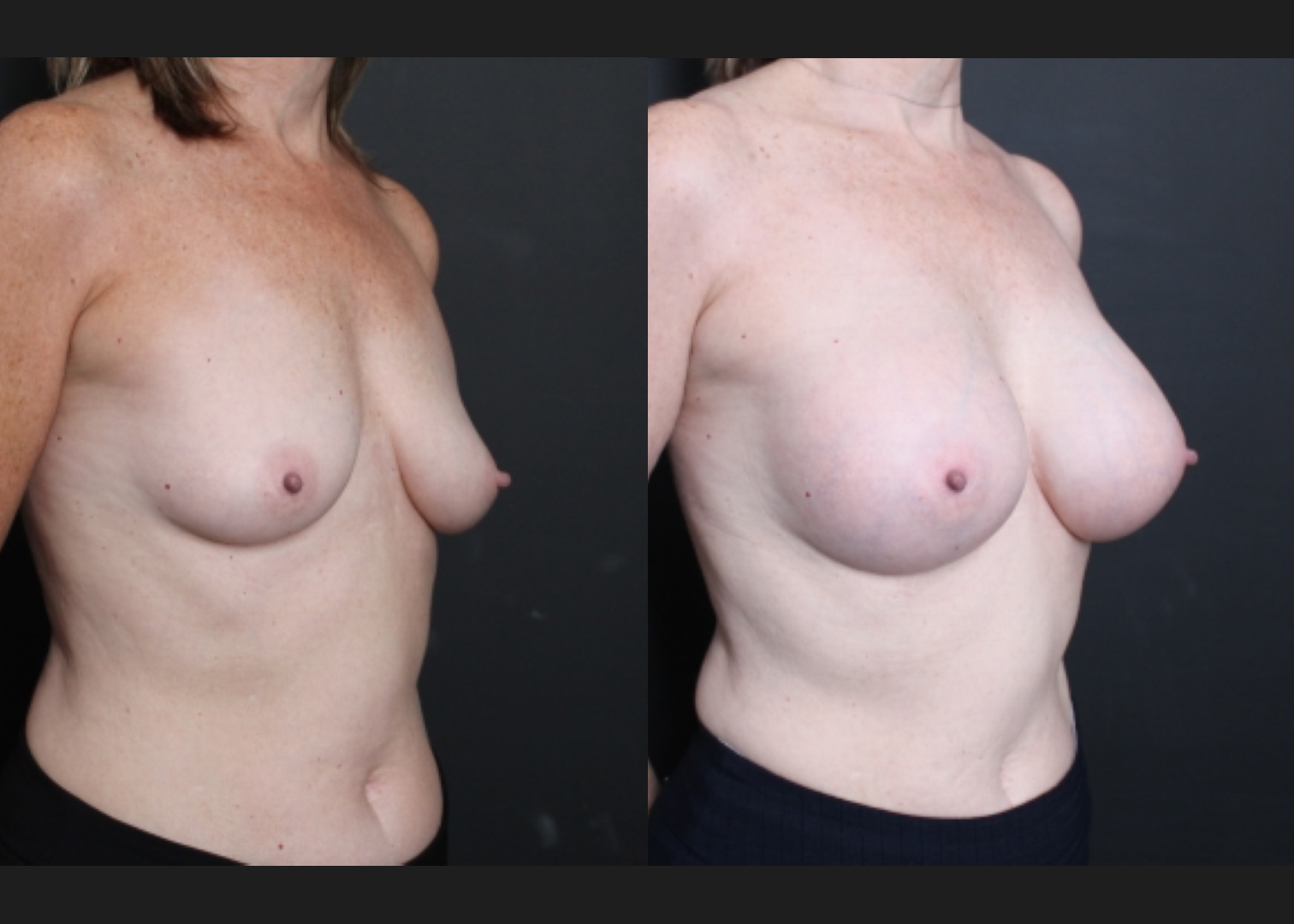 Breast augmentation sientra HSC+ smooth round high profile silicone gel gummy bear implants 415 cc subfascial before after- right oblique