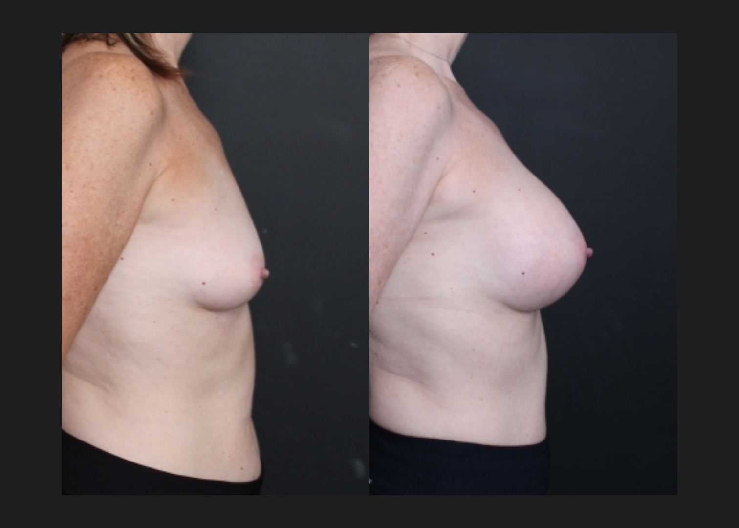 Breast augmentation sientra HSC+ smooth round high profile silicone gel gummy bear implants 415 cc subfascial before after- right