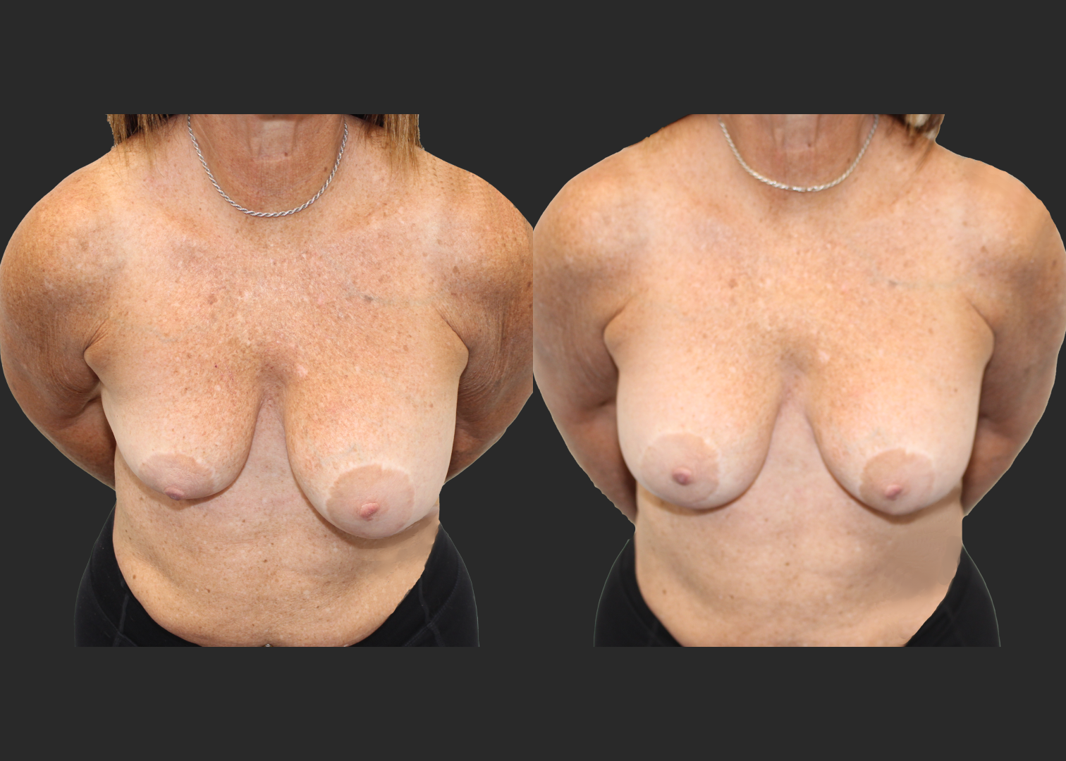 Breast implant revision severe asymmetry lift explant correction Natrelle inspira silicone gel gummy bear implants smooth round moderate profile SSM 210 cc before after- cleavage