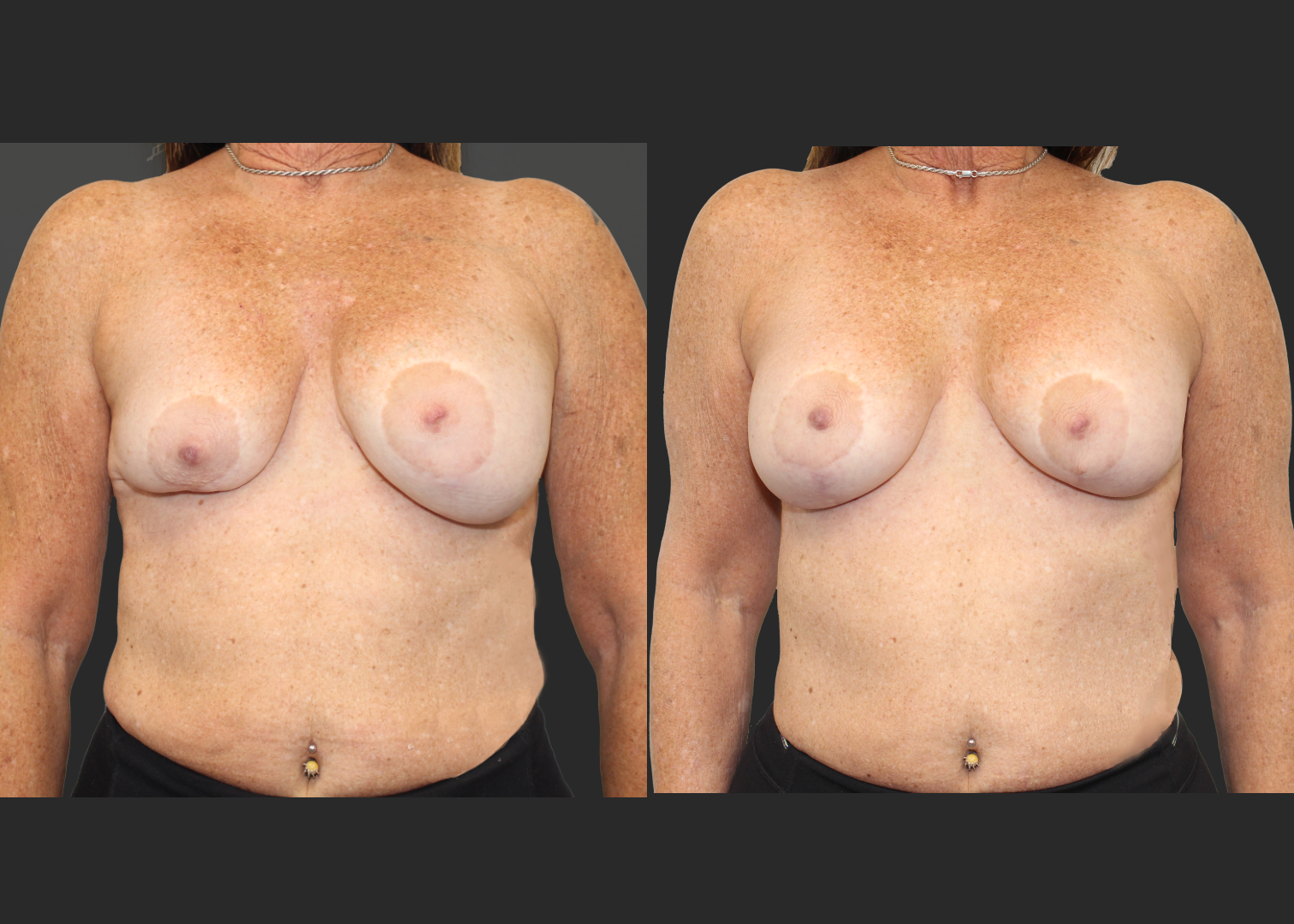 Breast implant revision severe asymmetry lift explant correction Natrelle inspira silicone gel gummy bear implants smooth round moderate profile SSM 210 cc before after- front