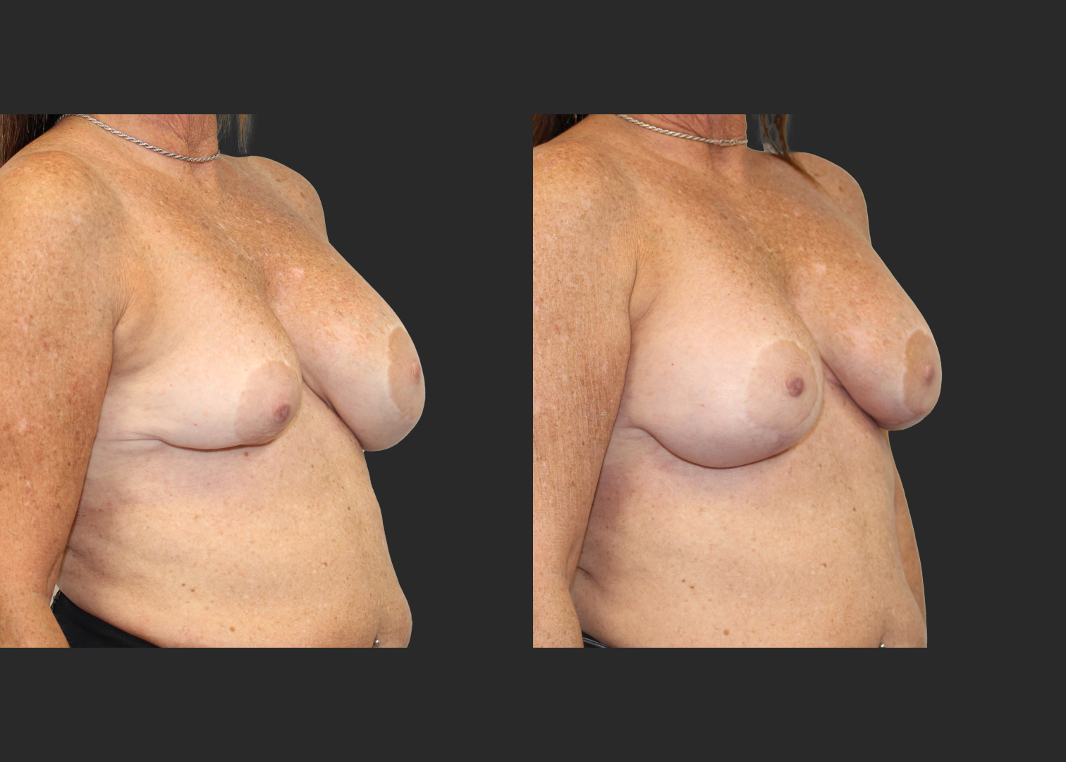 Breast implant revision severe asymmetry lift explant correction Natrelle inspira silicone gel gummy bear implants smooth round moderate profile SSM 210 cc before after- right oblique