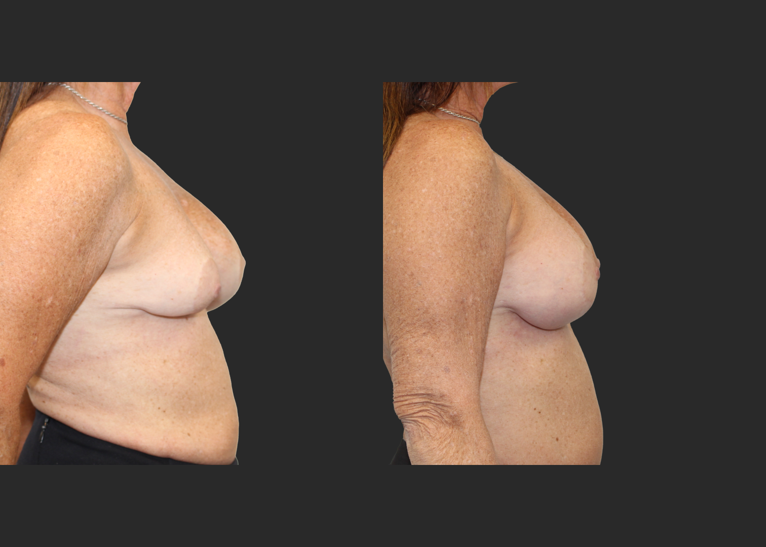 Breast implant revision severe asymmetry lift explant correction Natrelle inspira silicone gel gummy bear implants smooth round moderate profile SSM 210 cc before after- right