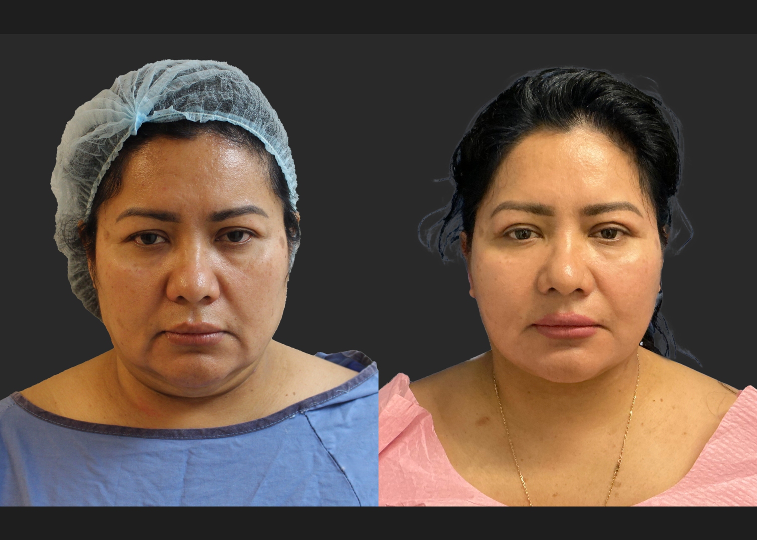 Facelift Necklift Upper Blepharoplasty Delta SMAS Plication Before After- front