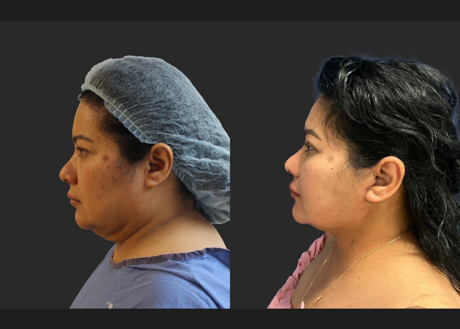Facelift Necklift Upper Blepharoplasty Delta SMAS Plication Before After- left