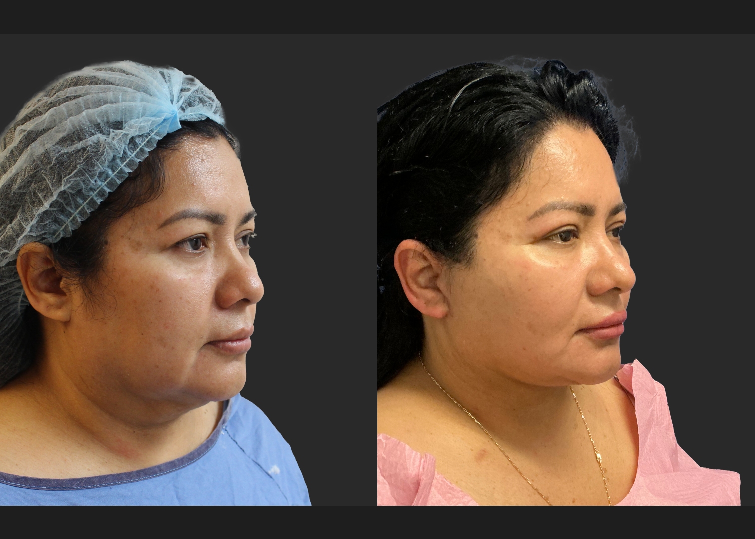 Facelift Necklift Upper Blepharoplasty Delta SMAS Plication Before After- right oblique