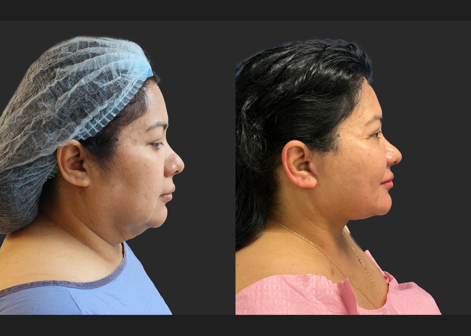Facelift Necklift Upper Blepharoplasty Delta SMAS Plication Before After- right