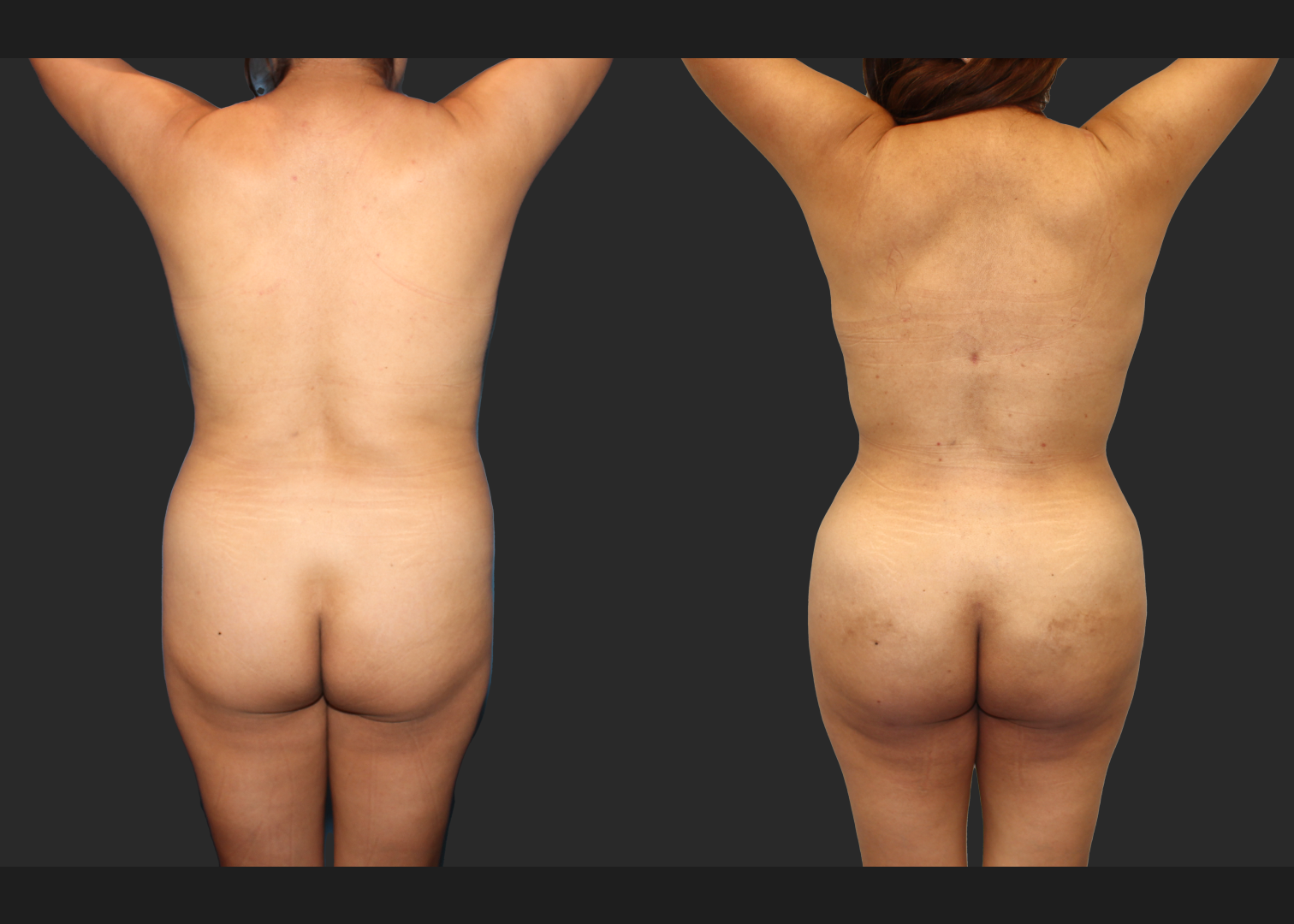 Lipo 350 Renuvion Abdomen Back BBL Fat transfer to buttock middle aged woman before after- back arms raised