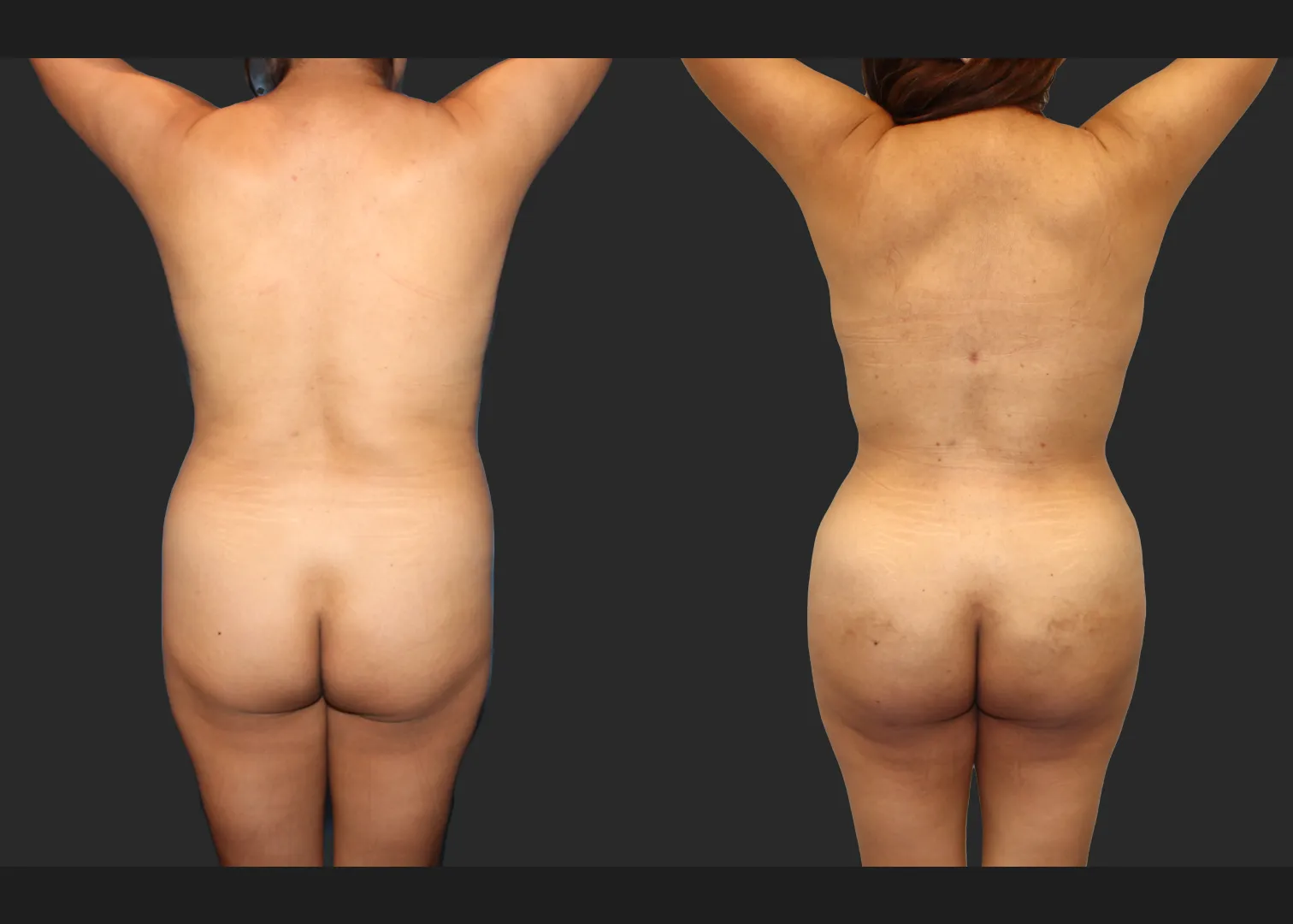 Lipo 350 Renuvion Abdomen Back BBL Fat transfer to buttock middle aged woman before after- back arms raised