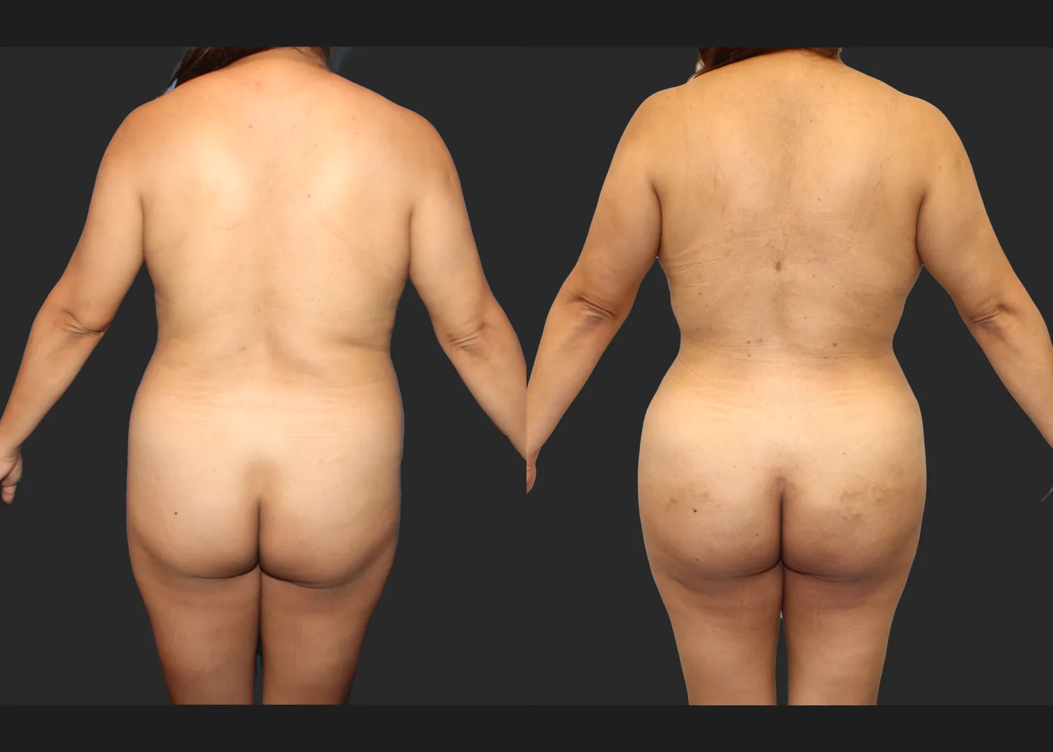 Lipo 350 Renuvion Abdomen Back BBL Fat transfer to buttock middle aged woman before after- back