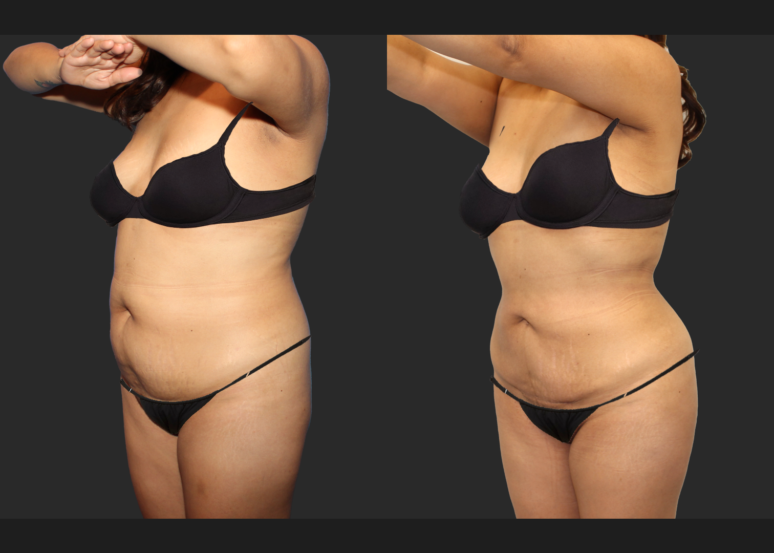 Lipo 350 Renuvion Abdomen Back BBL Fat transfer to buttock middle aged woman before after- front left oblique w underwear