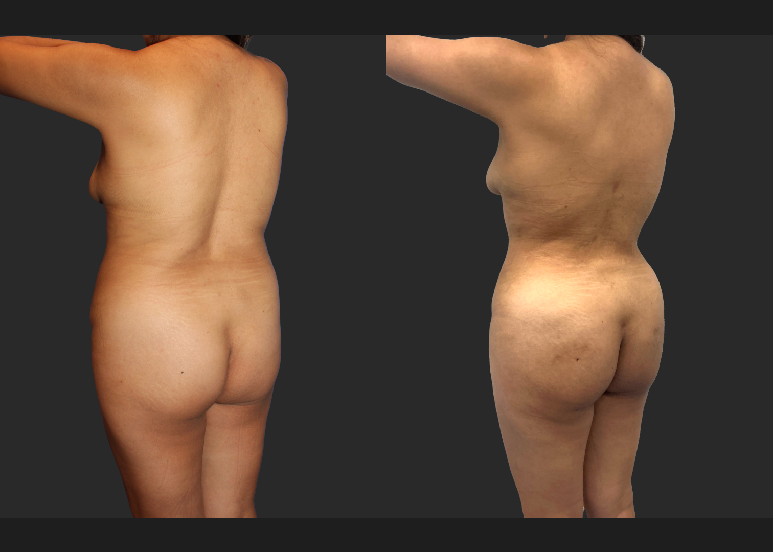 Lipo 350 Renuvion Abdomen Back BBL Fat transfer to buttock middle aged woman before after- left oblique